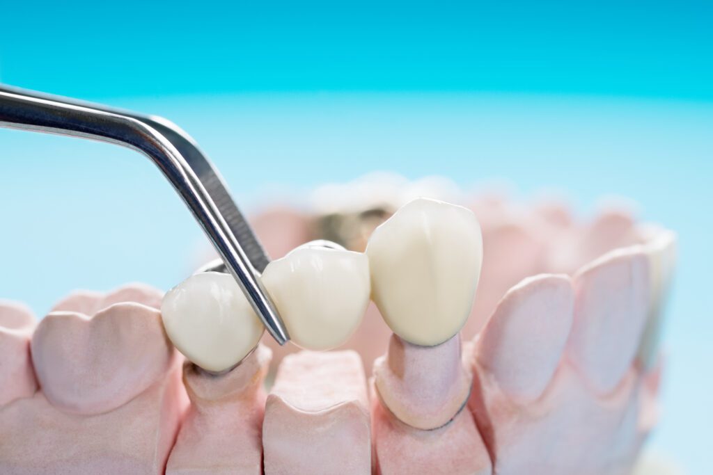 Dental Bridge Treatment in Tulsa, OK