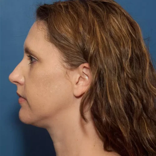 after dentistry at Hope Restorative & Cosmetic Dentistry